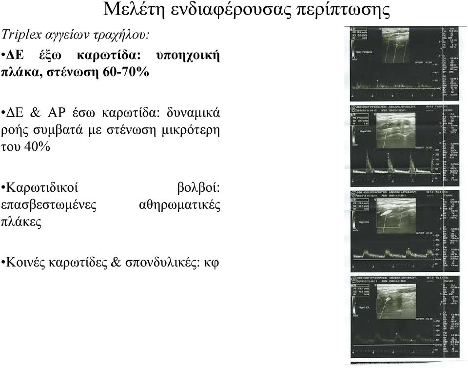 δυναμικά ροής συμβατά με στένωση μικρότερη του 40% Καρωτιδικοί