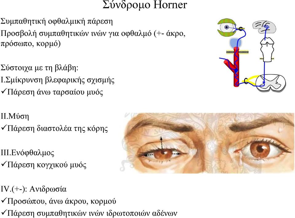 Σμίκρυνση βλεφαρικής σχισμής Πάρεση άνω ταρσαίου μυός II.