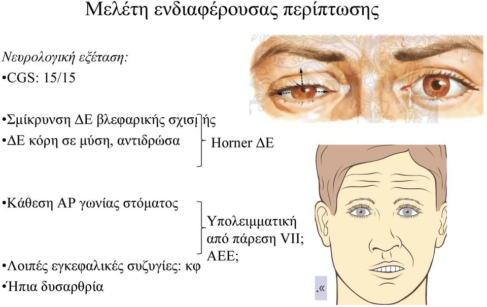 αντιδρώσα Horner ΔΕ Κάθεση ΑΡ γωνίας στόματος Λοιπές