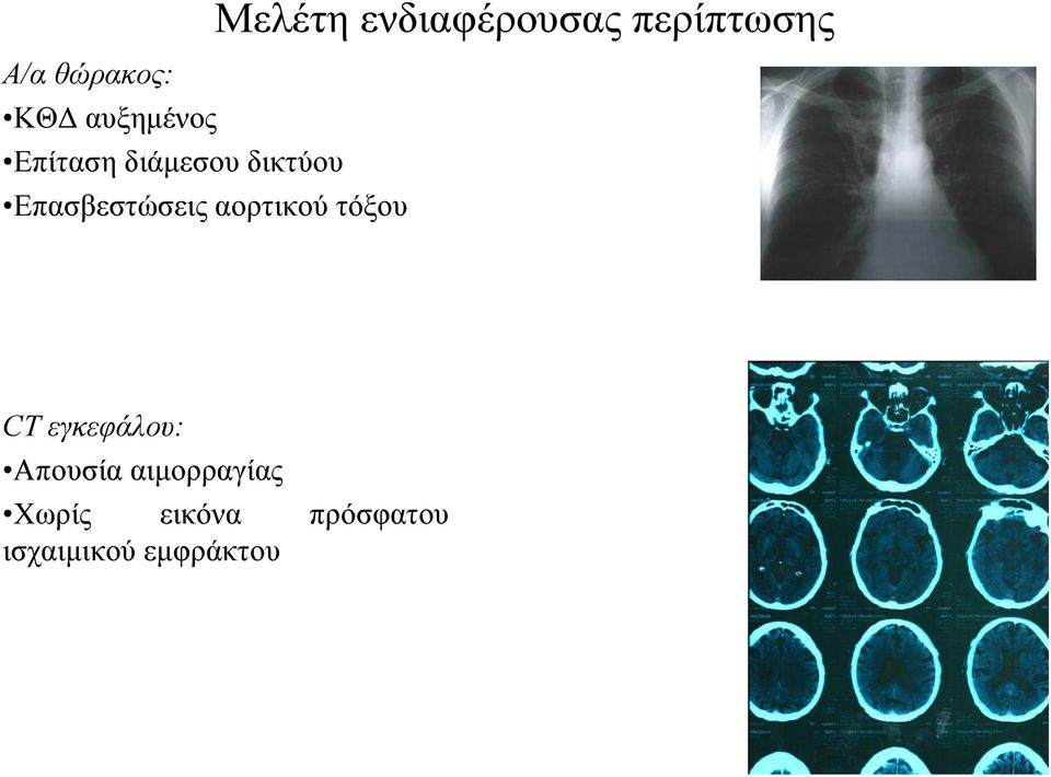 ενδιαφέρουσας περίπτωσης CT εγκεφάλου: Απουσία