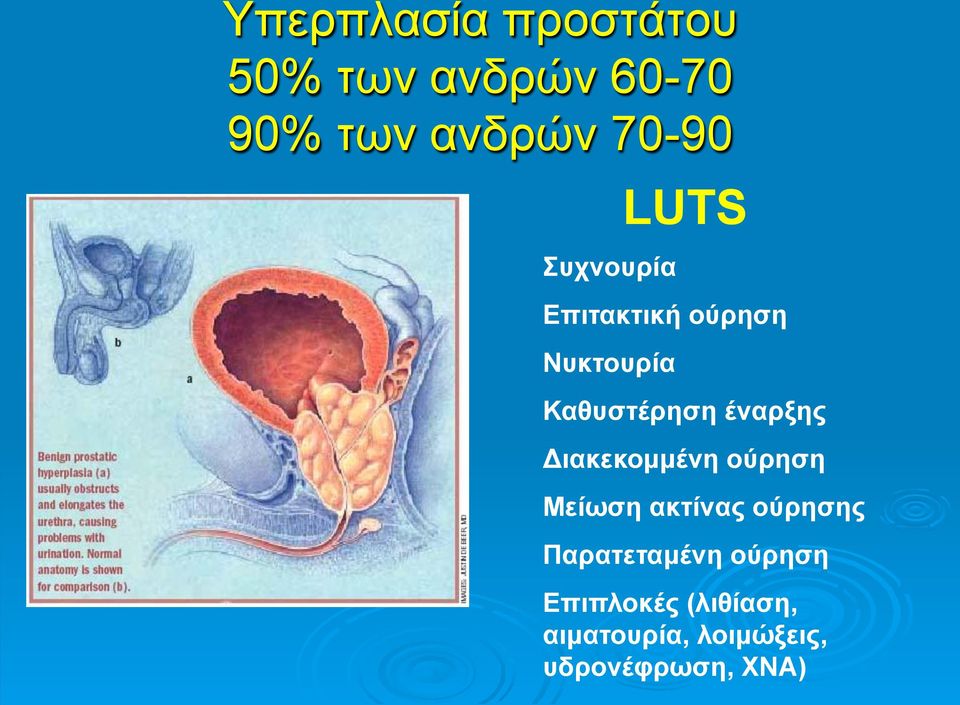 Διακεκοµµένη ούρηση Μείωση ακτίνας ούρησης Παρατεταµένη ούρηση