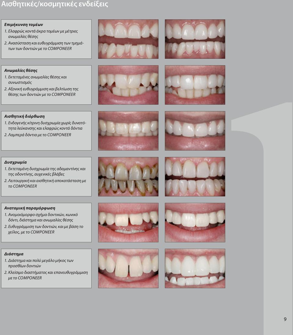 Ενδογενής κίτρινη δυσχρωμία χωρίς δυνατότητα λεύκανσης και ελαφρώς κοντά δόντια 2. Λαμπερά δόντια με το Componeer Δυσχρωμία 1.