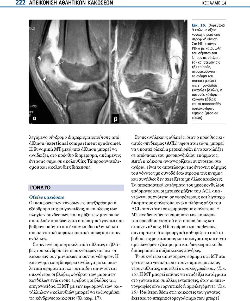 κάκωση (βέλος) και το αποσπασθέν οστεοχόνδρινο τεμάχιο (μέσα σε κύκλο). λεγόμενο σύνδρομο διαμερισματοποίησης από άθληση (exertional compartment syndrome).