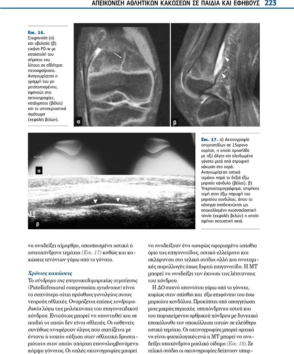 α) Ακτινογραφία επιγονατίδων σε 15χρονο κορίτσι, η οποία προσήλθε με οξύ άλγος και κλειδωμένο γόνατο μετά από στροφική κάκωση στο χορό.