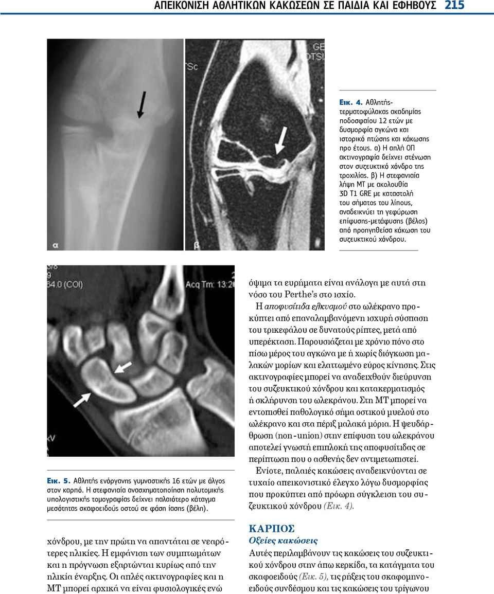 β) Η στεφανιαία λήψη ΜΤ με ακολουθία 3D T1 GRE με καταστολή του σήματος του λίπους, αναδεικνύει τη γεφύρωση επίφυσης-μετάφυσης (βέλος) από προηγηθείσα κάκωση του συζευκτικού χόνδρου. Εικ. 5.