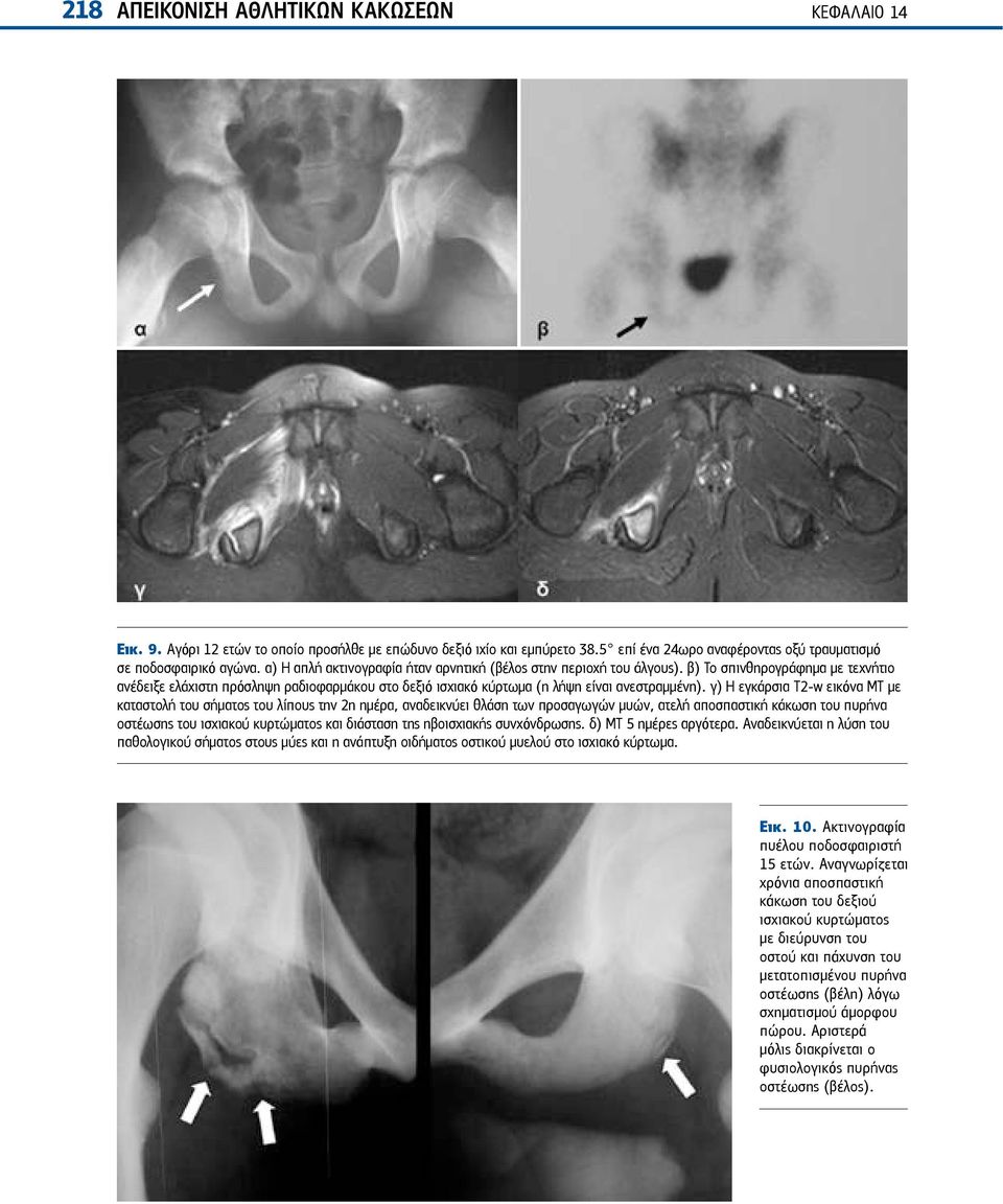 γ) Η εγκάρσια Τ2-w εικόνα ΜΤ με καταστολή του σήματος του λίπους την 2η ημέρα, αναδεικνύει θλάση των προσαγωγών μυών, ατελή αποσπαστική κάκωση του πυρήνα οστέωσης του ισχιακού κυρτώματος και διάσταση