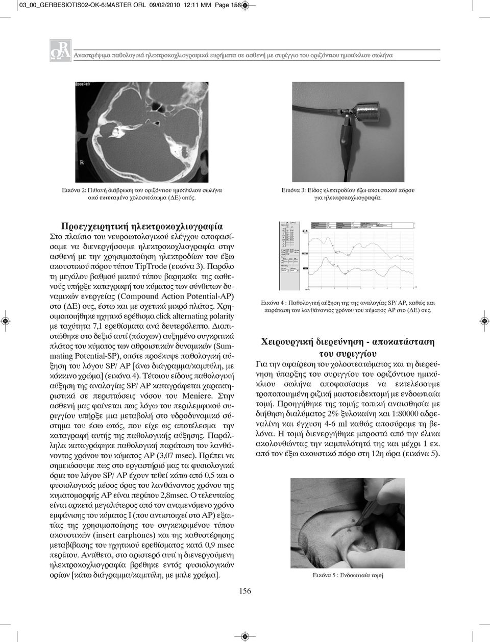 Προεγχειρητική ηλεκτροκοχλιογραφία Στο πλαίσιο του νευροωτολογικού ελέγχου αποφασίσαμε να διενεργήσουμε ηλεκτροκοχλιογραφία στην ασθενή με την χρησιμοποίηση ηλεκτροδίων του έξω ακουστικού πόρου τύπου