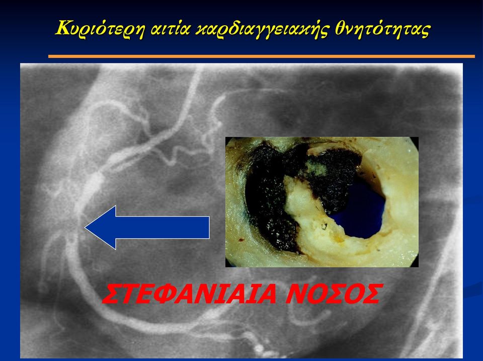 καρδιαγγειακής