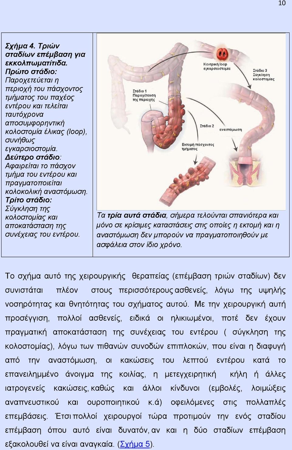 εύτερο στάδιο: Αφαιρείται το πάσχον τμήμα του εντέρου και πραγματοποιείται κολοκολική αναστόμωση. Τρίτο στάδιο: Σύγκληση της κολοστομίας και αποκατάσταση της συνέχειας του εντέρου.