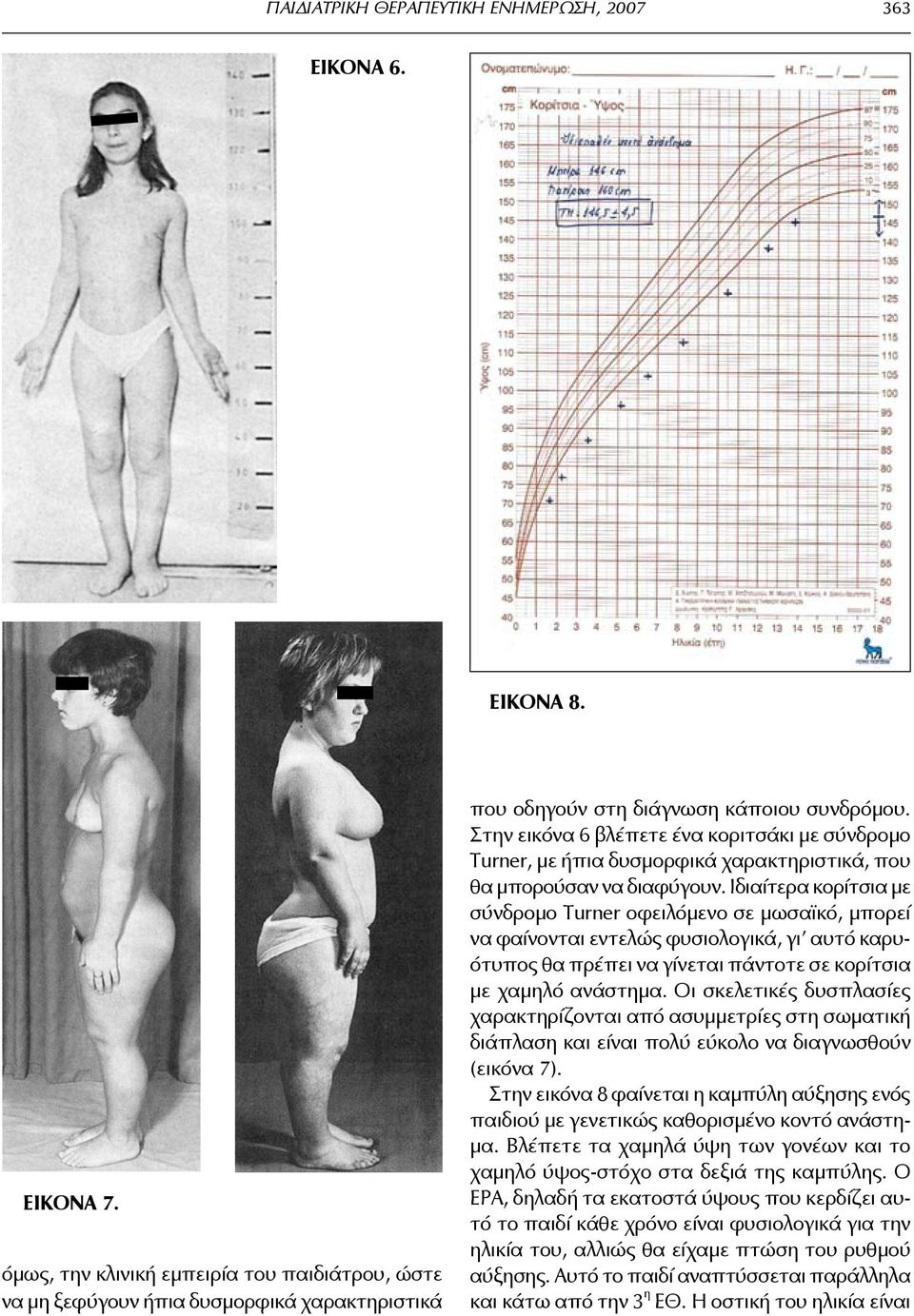 Στην εικόνα 6 βλέπετε ένα κοριτσάκι με σύνδρομο Turner, με ήπια δυσμορφικά χαρακτηριστικά, που θα μπορούσαν να διαφύγουν.
