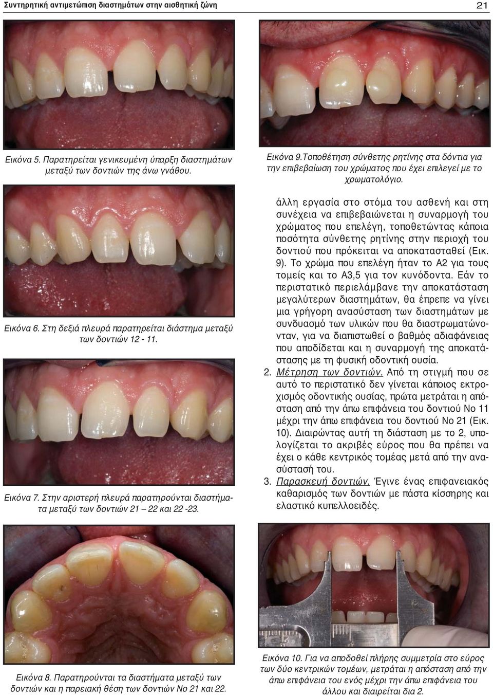 Τοποθέτηση σύνθετης ρητίνης στα δόντια για την επιβεβαίωση του χρώματος που έχει επιλεγεί με το χρωματολόγιο.