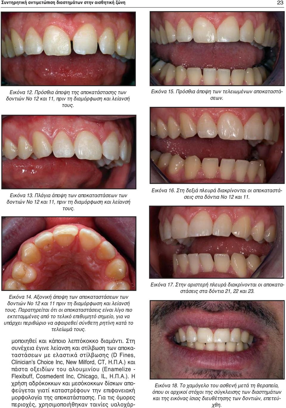 Στη δεξιά πλευρά διακρίνονται οι αποκαταστάσεις στα δόντια Νο 12 και 11. Εικόνα 14. Αξονική άποψη των αποκαταστάσεων των δοντιών Νο 12 και 11 πριν τη διαμόρφωση και λείανσή τους.