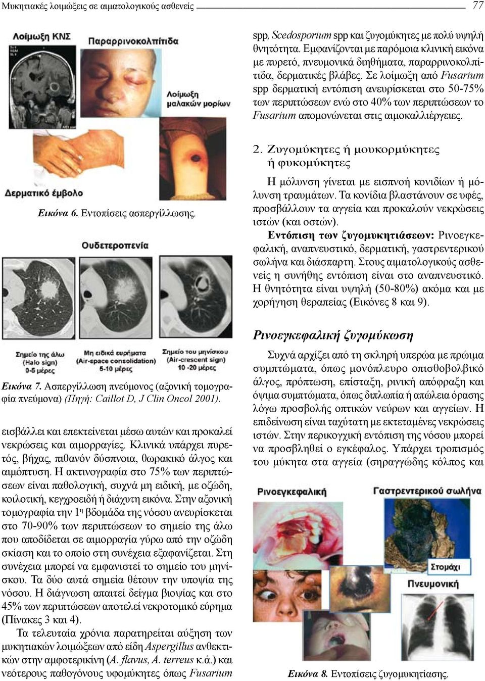 Σε λοίμωξη από Fusarium spp δερματική εντόπιση ανευρίσκεται στο 50-75% των περιπτώσεων ενώ στο 40% των περιπτώσεων το Fusarium απομονώνεται στις αιμοκαλλιέργειες. Εικόνα 6. Εντοπίσεις ασπεργίλλωσης.