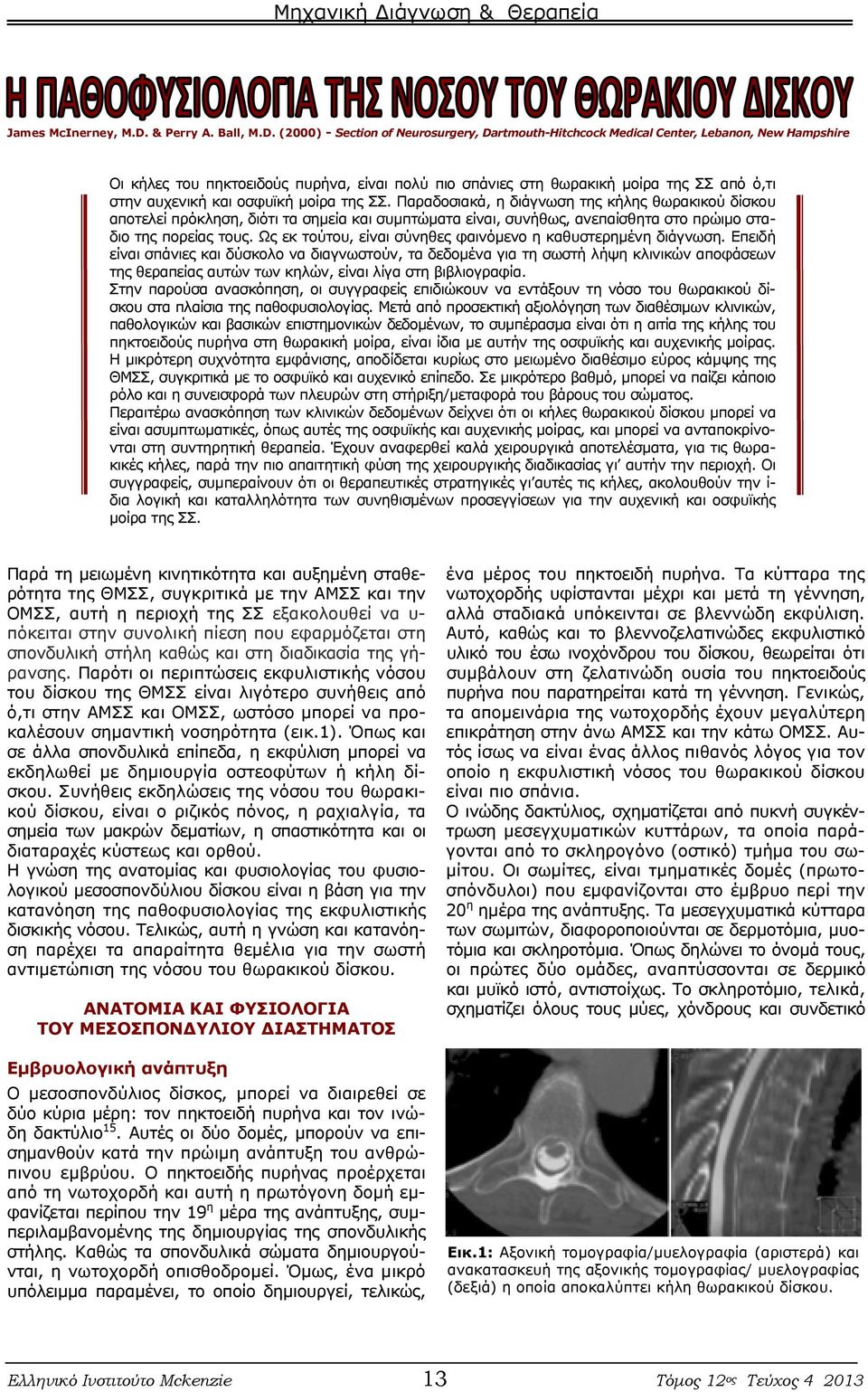 (2000) - Section of Neurosurgery, Dartmouth-Hitchcock Medical Center, Lebanon, New Hampshire Οι κήλες του πηκτοειδούς πυρήνα, είναι πολύ πιο σπάνιες στη θωρακική μοίρα της ΣΣ από ό,τι στην αυχενική