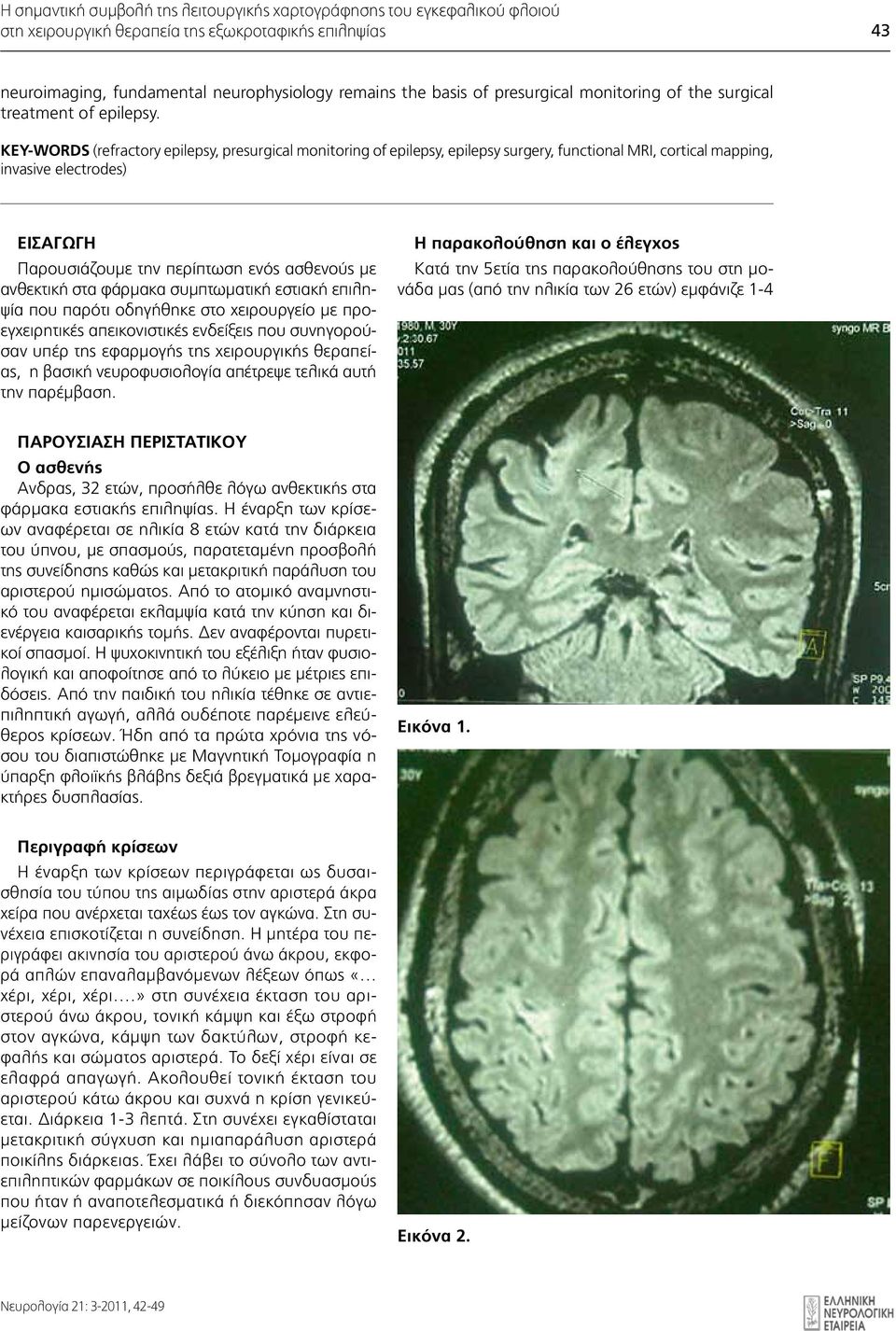 KEY-WORDS (refractory epilepsy, presurgical monitoring of epilepsy, epilepsy surgery, functional MRI, cortical mapping, invasive electrodes) ΕΙΣΑΓΩΓΗ Διμηνιαία Παρουσιάζουμε έκδοση της την περίπτωση