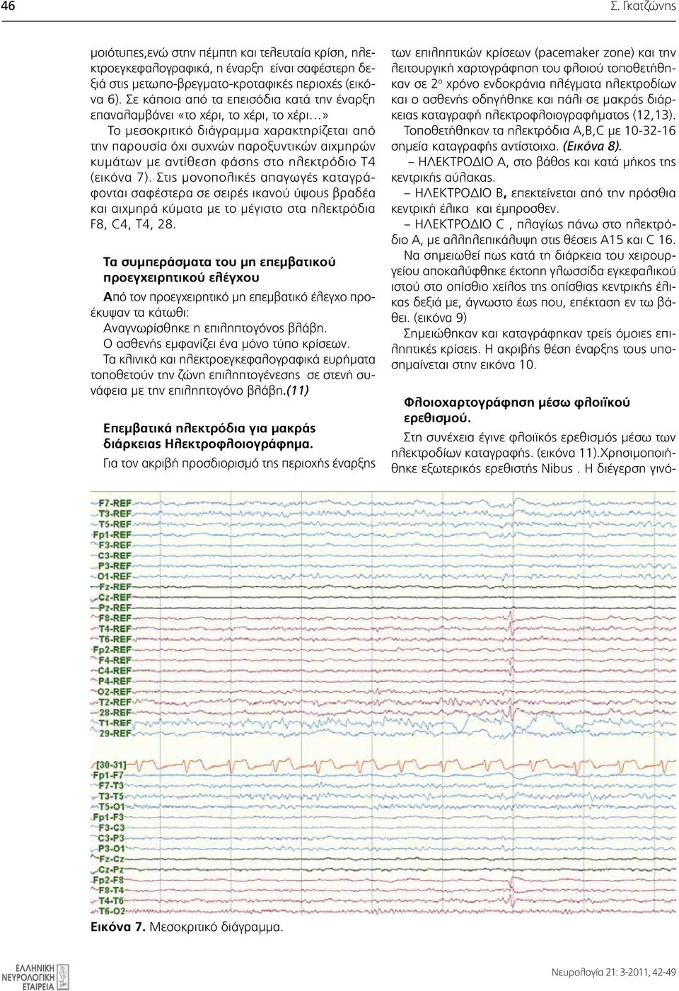 επαναλαμβάνει «το χέρι, το χέρι, το χέρι» Το μεσοκριτικό διάγραμμα χαρακτηρίζεται από Τοποθετήθηκαν τα ηλεκτρόδια A,B,C με 10-32-16 την παρουσία όχι συχνών παροξυντικών αιχμηρών σημεία καταγραφής