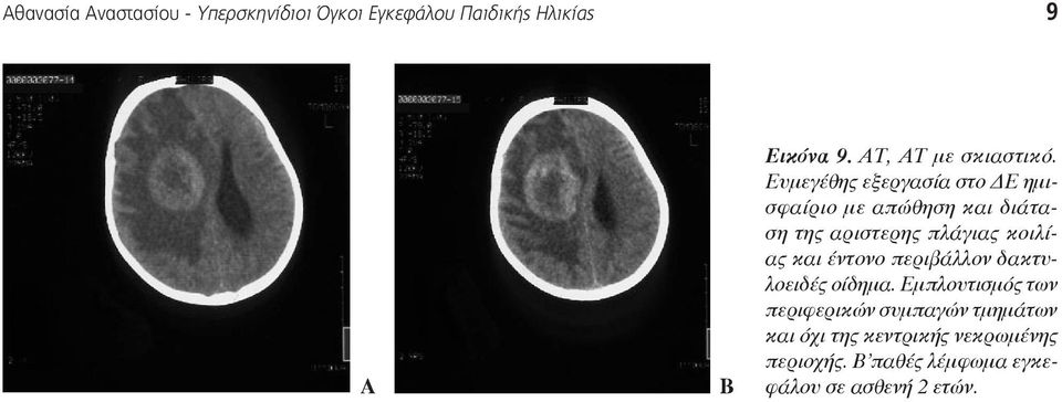 Ευμεγέθης εξεργασία στο Ε ημισφαίριο με απώθηση και διάταση της αριστερης πλάγιας κοιλίας