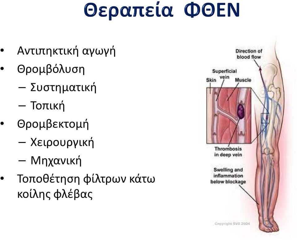 Θρομβεκτομή Χειρουργική