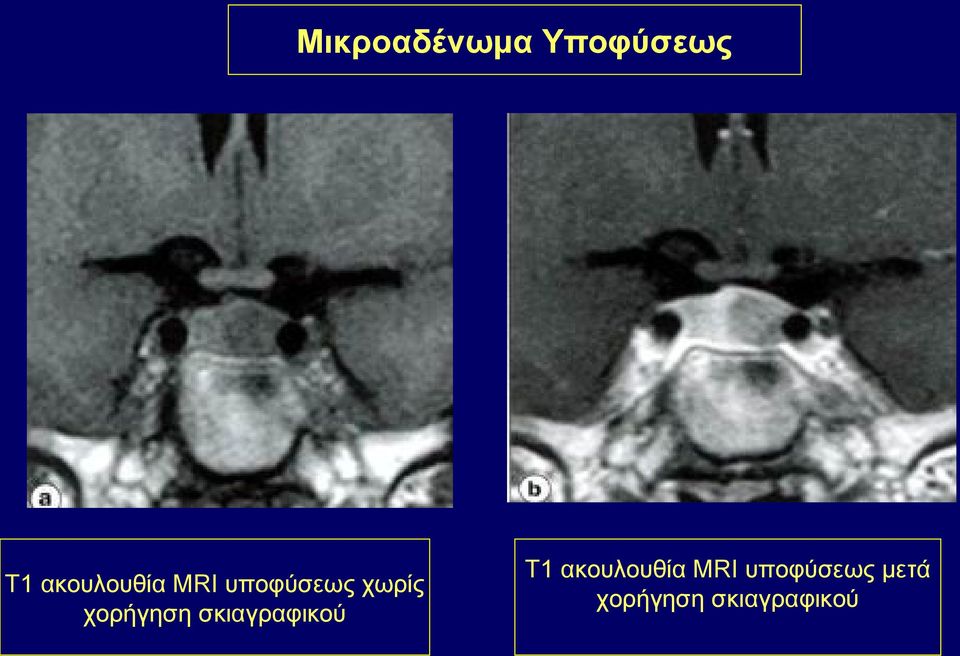 χορήγηση σκιαγραφικού Τ1
