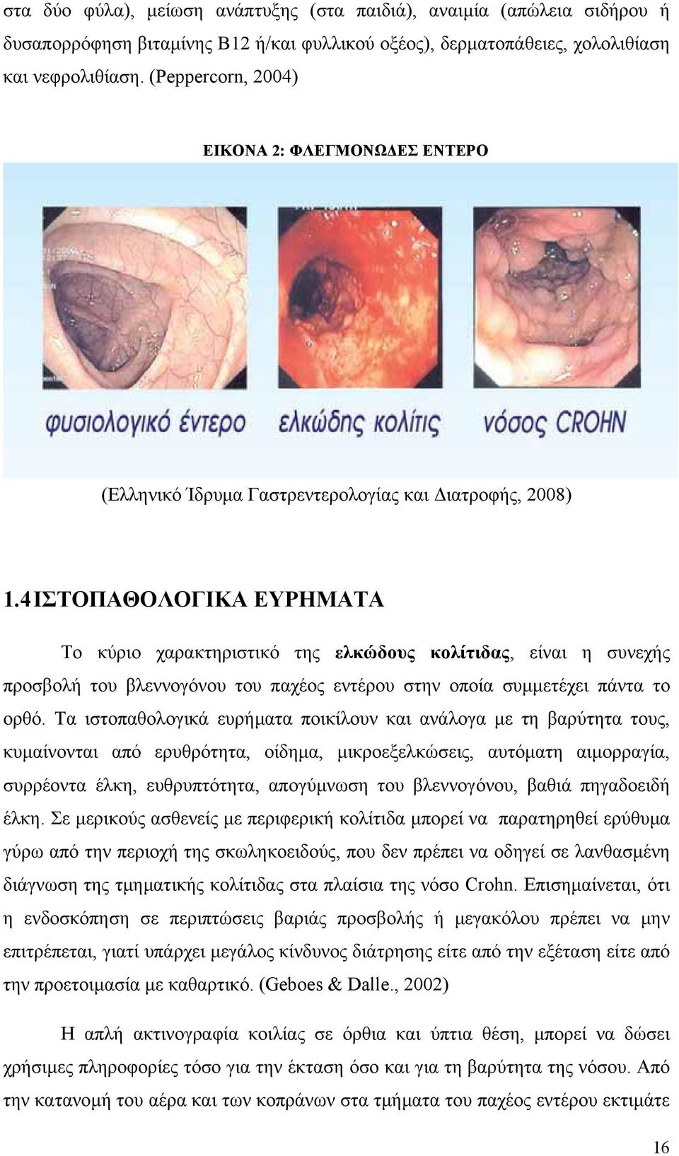 4 ΙΣΤΟΠΑΘΟΛΟΓΙΚΑ ΕΥΡΗΜΑΤΑ Το κύριο χαρακτηριστικό της ελκώδους κολίτιδας, είναι η συνεχής προσβολή του βλεννογόνου του παχέος εντέρου στην οποία συµµετέχει πάντα το ορθό.