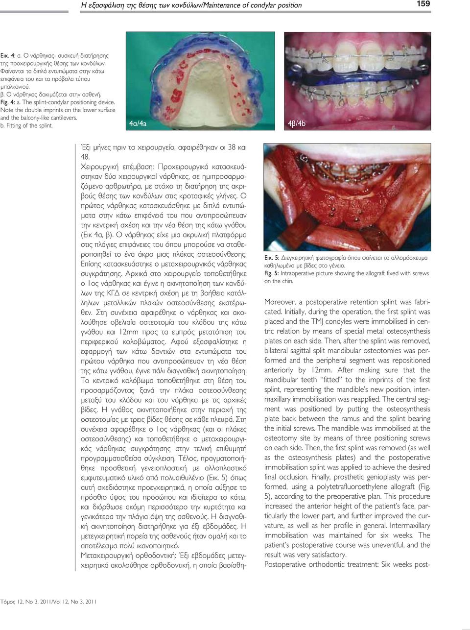 Note the double imprints on the lower surface and the balcony-like cantilevers. b. Fitting of the splint. 4α/4a 4β/4b Έξι μήνες πριν το χειρουργείο, αφαιρέθηκαν οι 38 και 48.