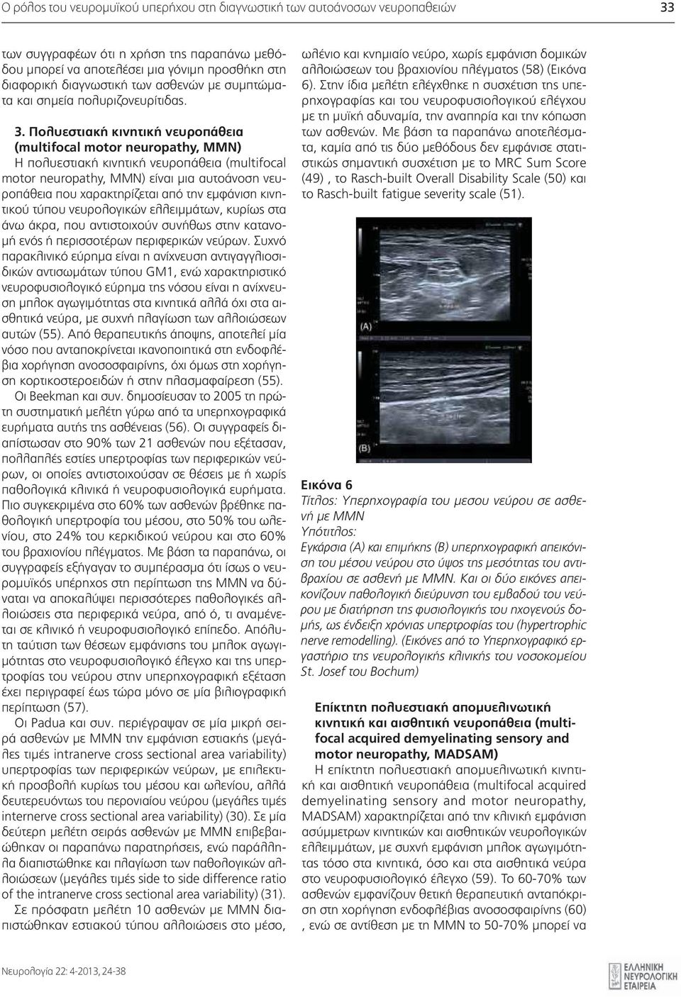 Πολυεστιακή κινητική νευροπάθεια (multifocal motor neuropathy, MMN) Η πολυεστιακή κινητική νευροπάθεια (multifocal motor neuropathy, MMN) είναι μια αυτοάνοση νευροπάθεια που χαρακτηρίζεται από την