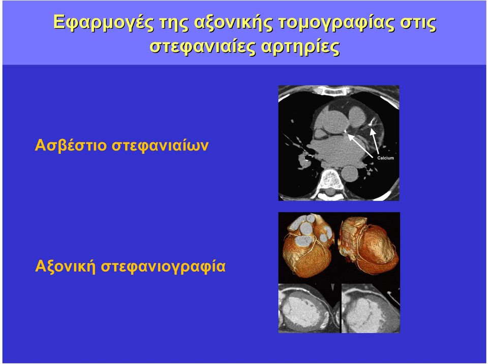 στεφανιαίες αρτηρίες