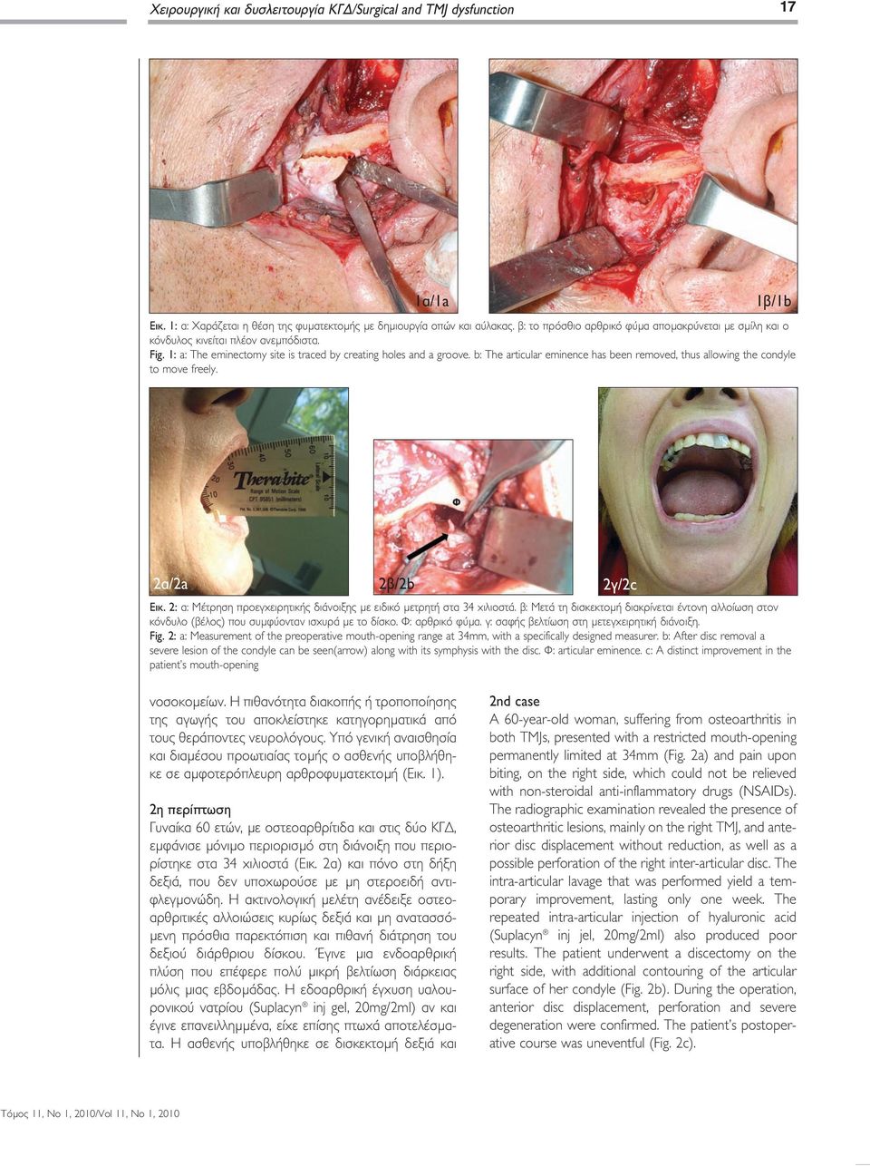 b: The articular eminence has been removed, thus allowing the condyle to move freely. 2α/2a 2β/2b 2γ/2c Εικ. 2: α: Μέτρηση προεγχειρητικής διάνοιξης με ειδικό μετρητή στα 34 χιλιοστά.