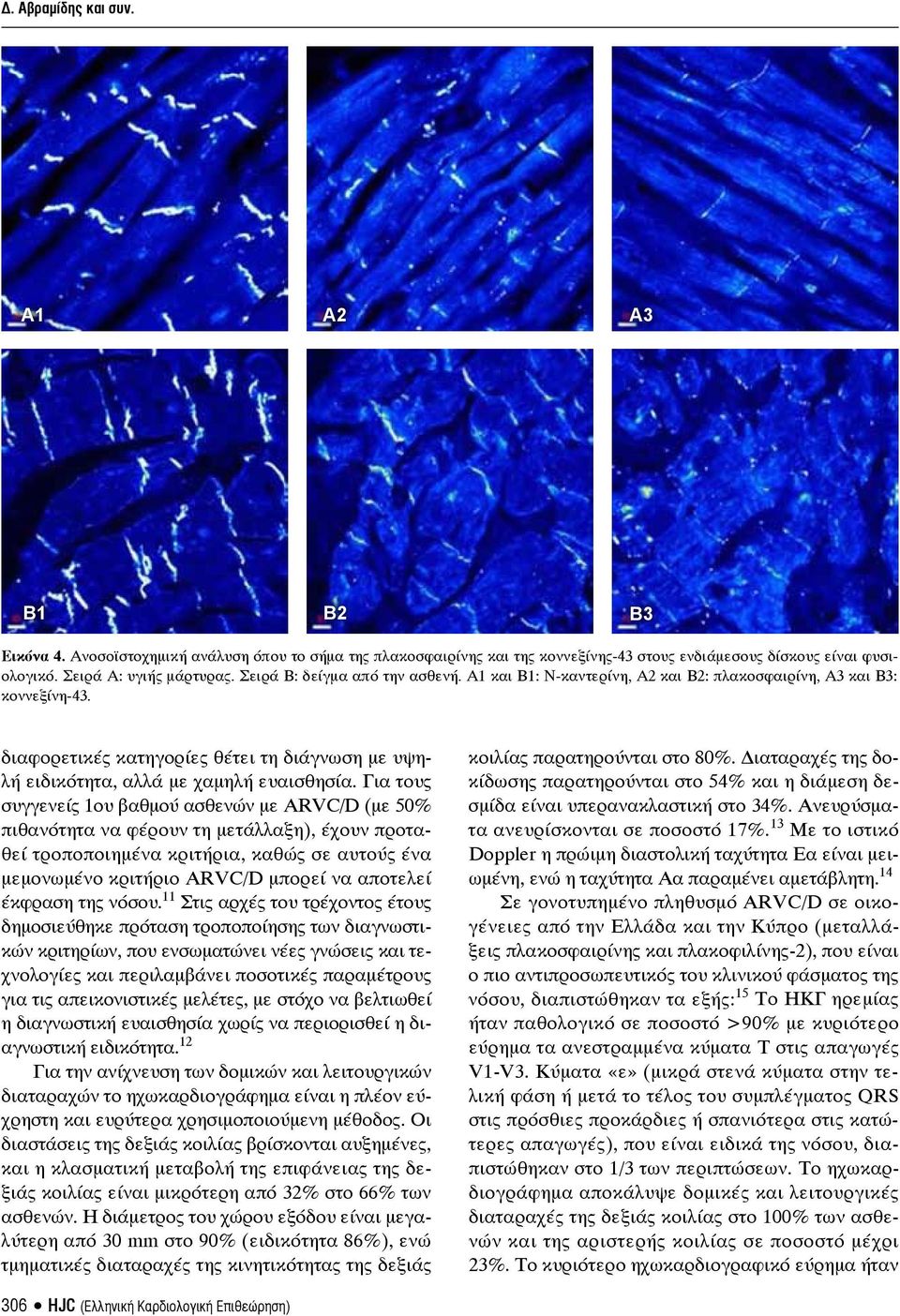 Για τους συγγενείς 1ου βαθμού ασθενών με ARVC/D (με 50% πιθανότητα να φέρουν τη μετάλλαξη), έχουν προταθεί τροποποιημένα κριτήρια, καθώς σε αυτούς ένα μεμονωμένο κριτήριο ARVC/D μπορεί να αποτελεί