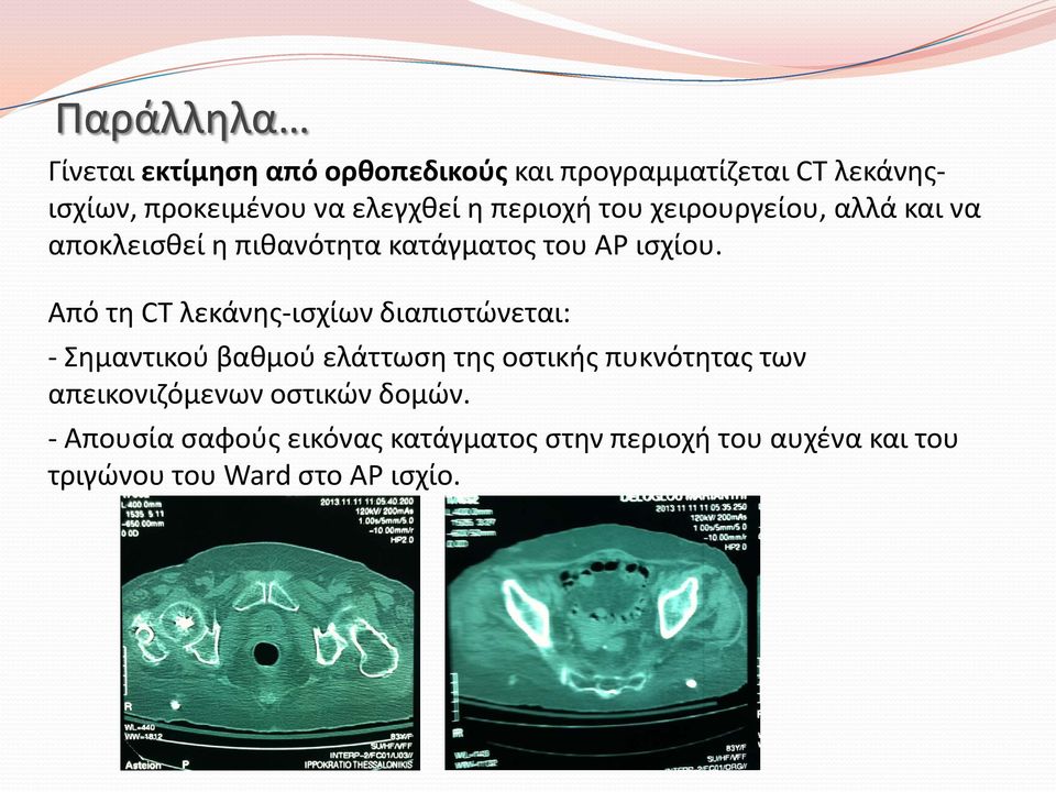 Από τη CT λεκάνης-ισχίων διαπιστώνεται: - Σημαντικού βαθμού ελάττωση της οστικής πυκνότητας των