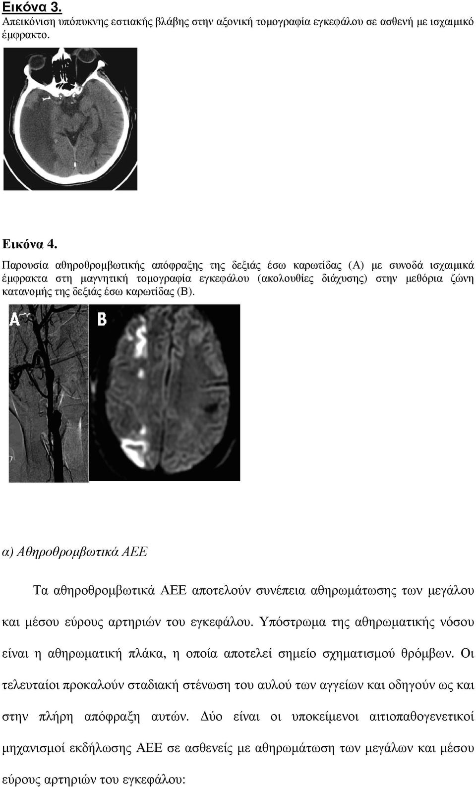 καρωτίδας (Β). α) Αθηροθροµβωτικά ΑΕΕ Τα αθηροθροµβωτικά ΑΕΕ αποτελούν συνέπεια αθηρωµάτωσης των µεγάλου και µέσου εύρους αρτηριών του εγκεφάλου.