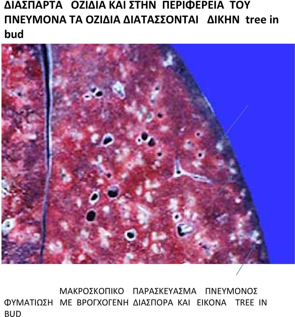 bud ΜΑΚΡΟΣΚΟΠΙΚΟ ΠΑΡΑΣΚΕΥΑΣΜΑ ΠΝΕΥΜΟΝΟΣ