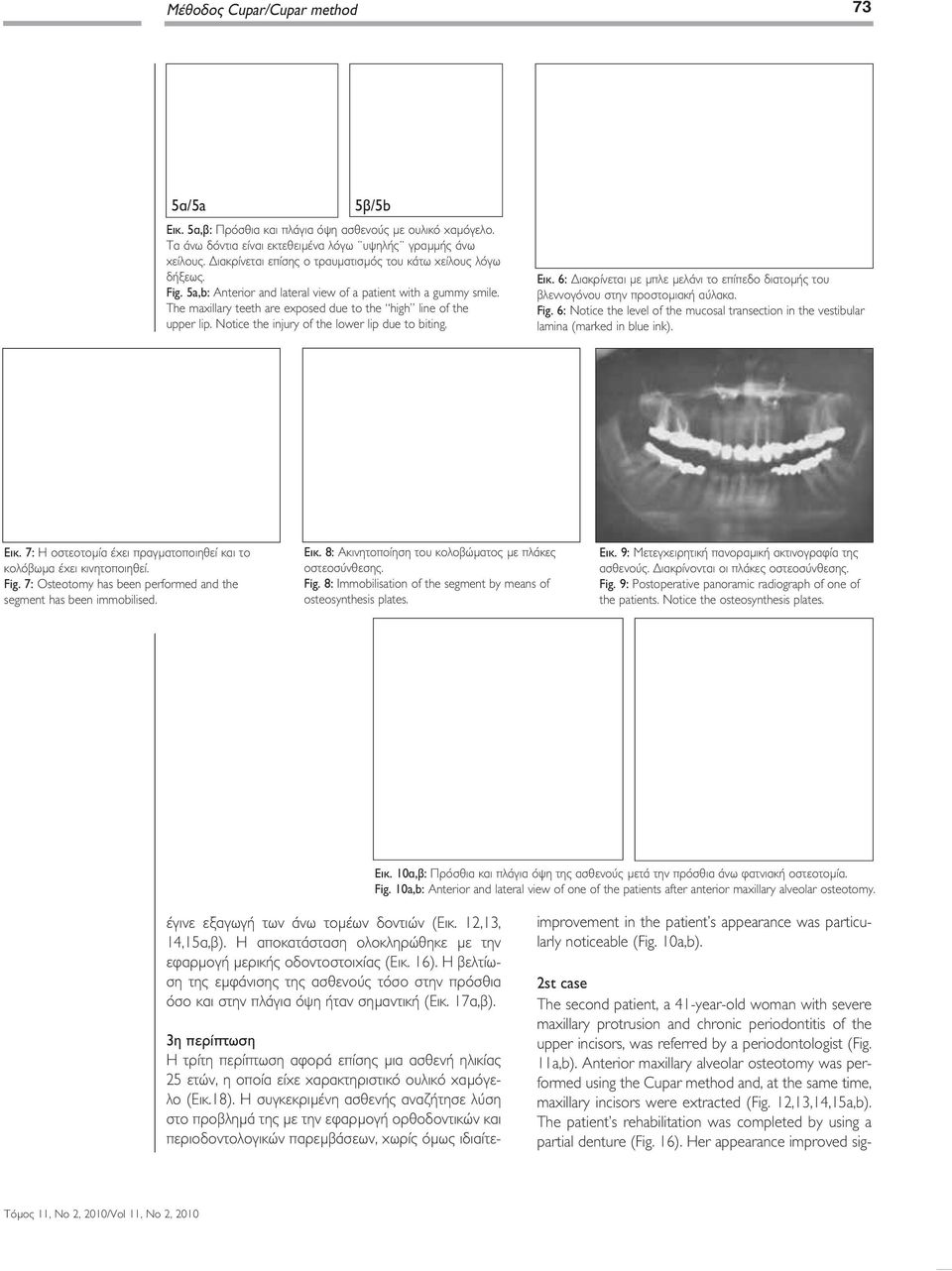 The maxillary teeth are exposed due to the high line of the upper lip. Notice the injury of the lower lip due to biting. Εικ.