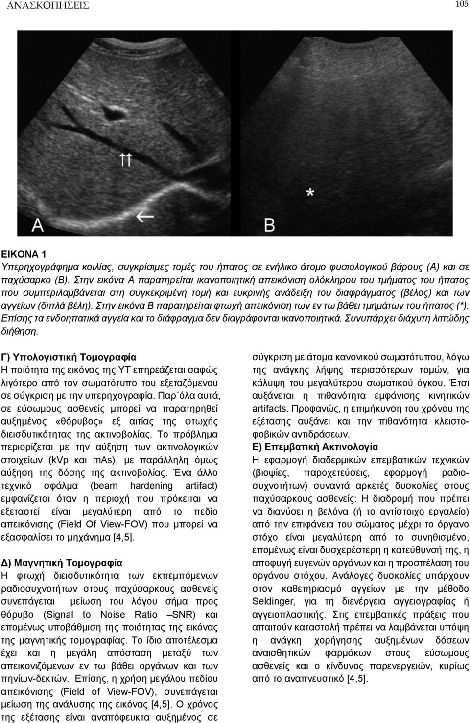 βέλη). Στην εικόνα Β παρατηρείται φτωχή απεικόνιση των εν τω βάθει τμημάτων του ήπατος (*). Επίσης τα ενδοηπατικά αγγεία και το διάφραγμα δεν διαγράφονται ικανοποιητικά.