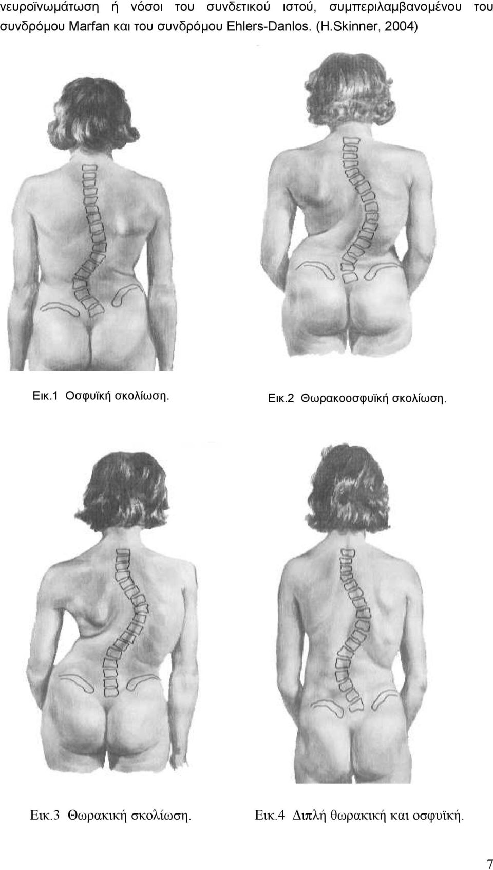 Ehlers-Danlos. (H.Skinner, 2004) Εικ.1 Οσφυϊκή σκολίωση. Εικ.2 Θωρακοοσφυϊκή σκολίωση.