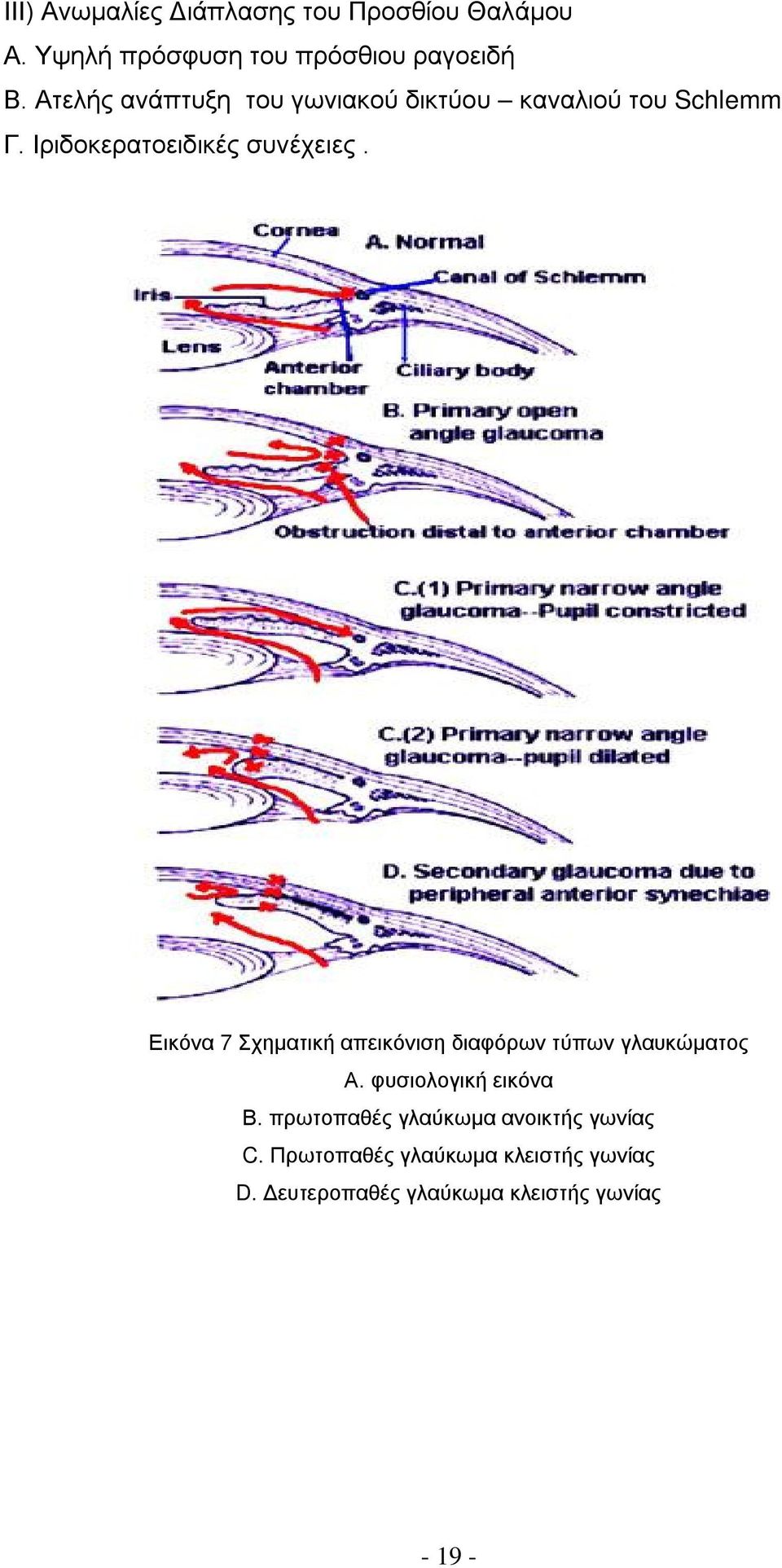 Εικόνα 7 Σχηματική απεικόνιση διαφόρων τύπων γλαυκώματος Α. φυσιολογική εικόνα Β.