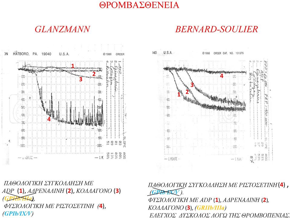 (GPIb/IX/V) ΠΑΘΟΛΟΓΙΚΗ ΣΥΓΚΟΛΛΗΣΗ ΜΕ ΡΙΣΤΟΣΕΤΙΝΗ(4), (GPIb/IX/V ).