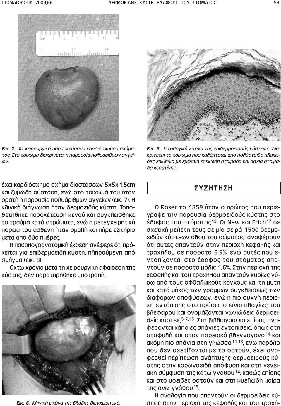 έχει καρδιόσχηµο σχήµα διαστάσεων 5x5x1,5cm και ζυµώδη σύσταση, ενώ στο τοίχωµά του ήταν ορατή η παρουσία πολυάριθµων αγγείων (εικ. 7). Η κλινική διάγνωση ήταν δερµοειδής κύστη.