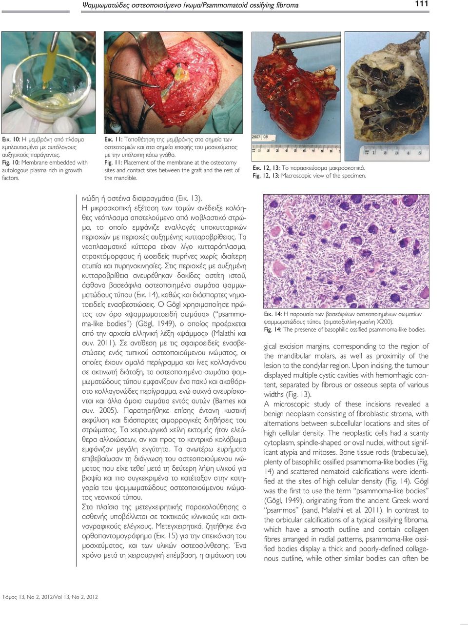 11: Placement of the membrane at the osteotomy sites and contact sites between the graft and the rest of the mandible. Εικ. 12, 13: Το παρασκεύασµα µακροσκοπικά. Fig.