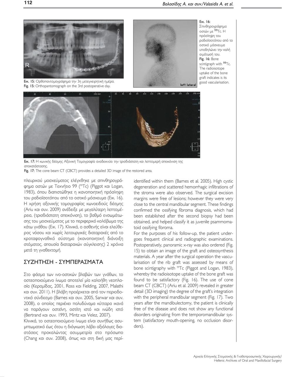 The radioisotope uptake of the bone graft indicates is its good vascularisation. Εικ. 17: Η κωνικής δέσµης Αξονική Τοµογραφία αναδεικνύει την τρισδιάστατη και λεπτοµερή απεικόνιση της αποκατάστασης.