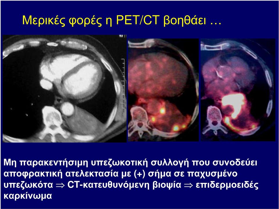 συνοδεύει αποφρακτική ατελεκτασία µε (+) σήµα