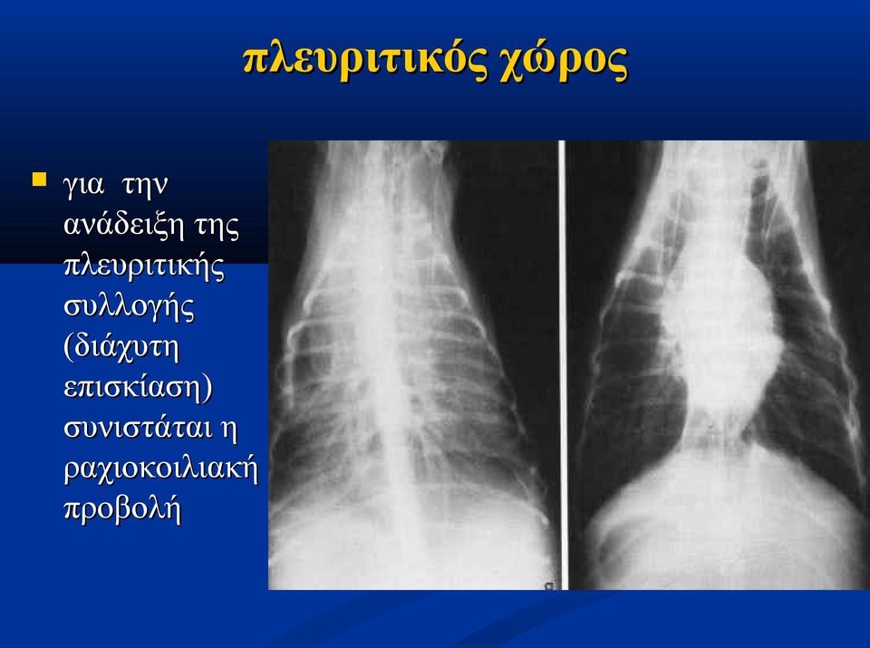 συλλογής (διάχυτη επισκίαση)