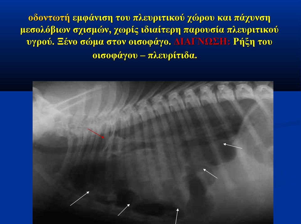 παρουσία πλευριτικού υγρού.