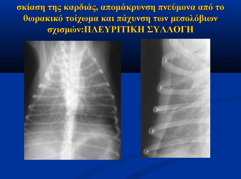θωρακικό τοίχωμα και πάχυνση