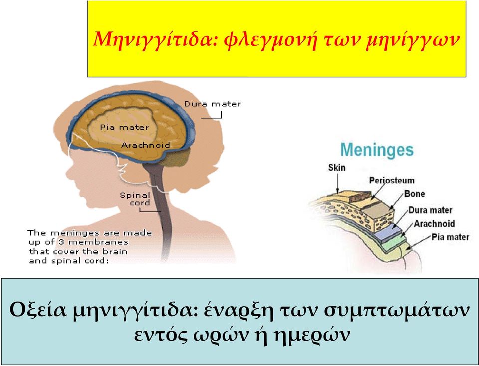 μηνιγγίτιδα: έναρξη των