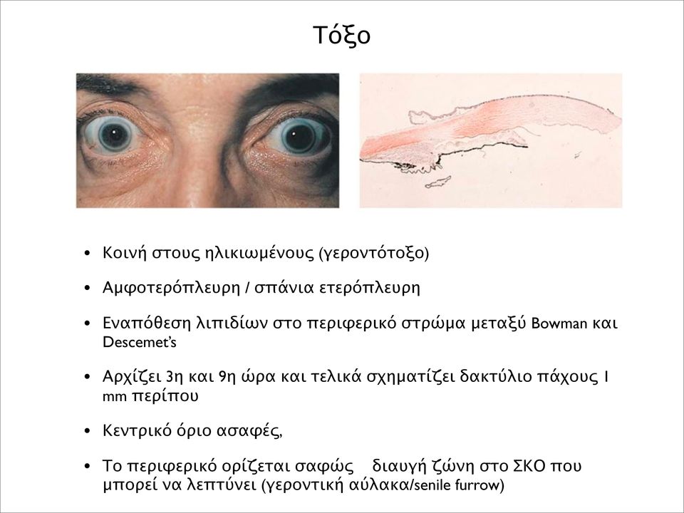 ώρα και τελικά σχηματίζει δακτύλιο πάχους 1 mm περίπου Κεντρικό όριο ασαφές, Το