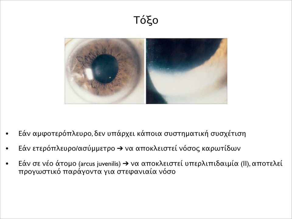 καρωτίδων Εάν σε νέο άτομο (arcus juvenilis) να αποκλειστεί