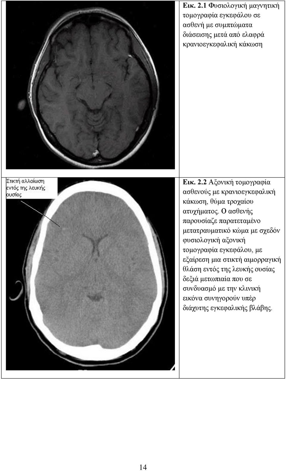 Ο ασθενής παρουσίαζε παρατεταμένο μετατραυματικό κώμα με σχεδόν φυσιολογική αξονική τομογραφία εγκεφάλου, με εξαίρεση