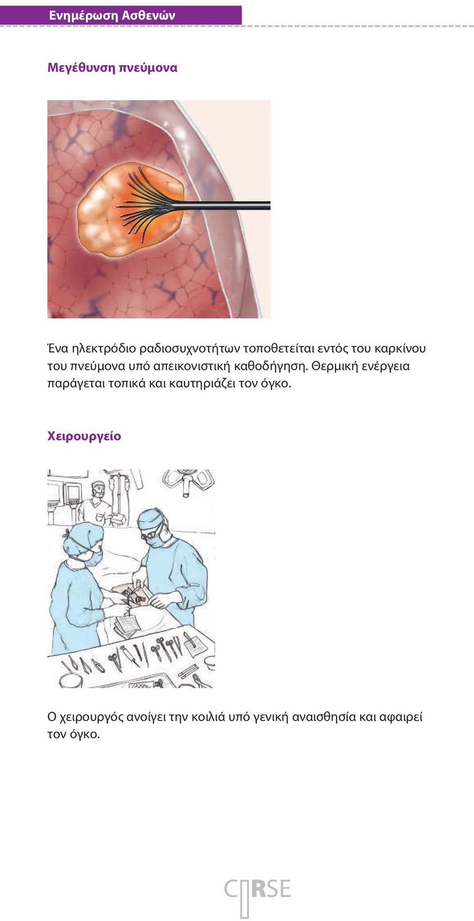 Θερμική ενέργεια παράγεται τοπικά και καυτηριάζει τον όγκο.