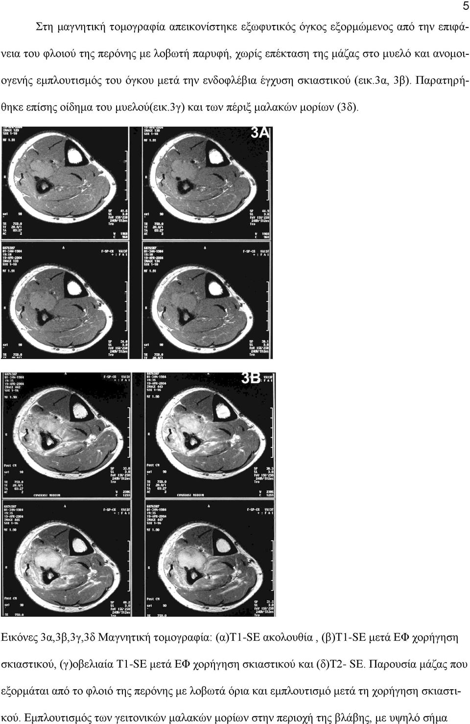 Εικόνες 3α,3β,3γ,3δ Μαγνητική τομογραφία: (α)τ1-se ακολουθία, (β)τ1-se μετά ΕΦ χορήγηση σκιαστικού, (γ)οβελιαία Τ1-SE μετά ΕΦ χορήγηση σκιαστικού και (δ)τ2- SE.